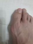 Боль косточки на пальце правой ноги фото 2