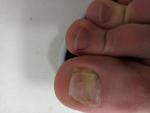 Желтое пятно на ногте большого пальца ноги фото 1
