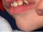Налёт на зубах у ребенка фото 1