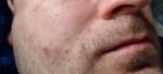 Язвочки на лице и возле ноздрей, шелушение фото 3