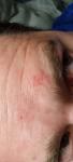 Язвочки на лице и возле ноздрей, шелушение фото 4