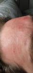 Язвочки на лице и возле ноздрей, шелушение фото 5