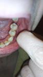 Оголение шейки зуба фото 2
