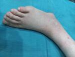Падагрический артрит, жалобы в течении 10 лет, частые обострения фото 2