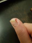 Трещины на пальцах рук у ногтя фото 1