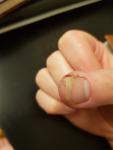 Трещины на пальцах рук у ногтя фото 2