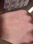 Шелушение кожи на руке фото 2