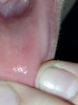 Странное воспаление на внутренней стороне губы фото 4