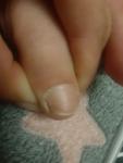 Грибок нігтів фото 1