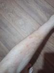 Бледные высыпания на ногах фото 2