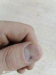 Ногти ломкие фото 1