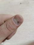 Ногти тонкие и ломкие фото 2