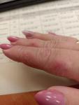 Сухие участки кожи на пальцах рук фото 2