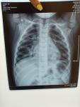 Постановка диагноза по рентген снимку, пневмония или бронхит? фото 1