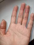 Утолщения на подушечках пальцев руки фото 1