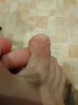 Прыщи на пальцах ноге фото 2