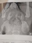 Дисплазия тазобедренного сустава, децентрация-справа, подвывих-слева. Ацетабулярные углы справа-31 слев фото 1