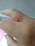 Сыпь и шелушение между пальцами руки фото 1