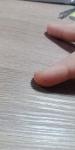 Коричневые пятна на кончиках пальцев возле ногтя фото 2
