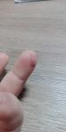 Коричневые пятна на кончиках пальцев возле ногтя фото 3