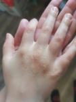 Сыпь на руках ребёнка 6 лет фото 1