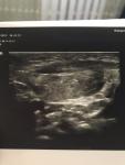 Мышечная кривошея новорожденного фото 1