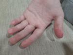 Шелушение подушечек пальцев у ребенка и покраснение фото 1