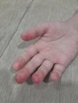 Шелушение подушечек пальцев у ребенка и покраснение фото 2