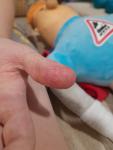 Шелушение подушечек пальцев у ребенка и покраснение фото 4