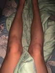 Травма коленного сустава/ушиб фото 2