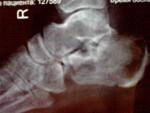 Перелом пяточной кости фото 1