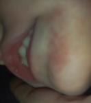 Аллергия или другое фото 1