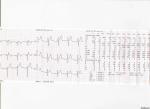 Расшифровка ЭКГ при шумах в сердце фото 2