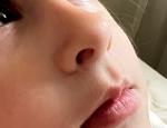 Высыпания на носу у ребенка фото 1