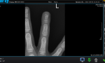 Перелом ногтевой фаланги пальца фото 1