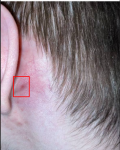 Участок инфильтрации за ухом фото 1