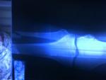 Перелом малоберцовой кости (и большеберцовой кости) фото 1