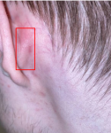 Участок инфильтрации за ухом фото 2