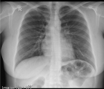 Расшифровка рентгена грудной полости фото 1