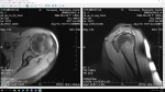 Расшифровка МРТ левого плечевого сустава фото 1