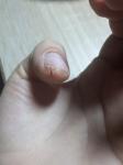 Проблемы с кожей на пальцах рук вокруг ногтей фото 1