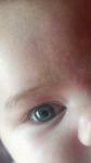 Пятнышко на роговице глаза у ребёнка фото 1