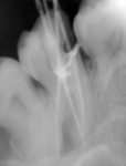 Болит область зуба без нервов фото 1