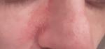 Красные пятна с двух сторон у носа, шелушение фото 4