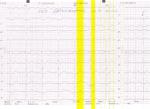 Сильное сердцебиение, нехватка воздуха, результат ЭКГ фото 1