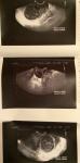 3 кисты яичников, лечение, возможность зачатия фото 1
