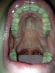 Воспаление горла, першение в горле фото 1