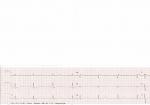 Расшифровка ЭКГ (Септальная аномалия волны зубца Т) фото 1