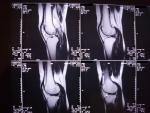 Операция при боли в колене фото 3