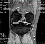 Травма колена, синовит фото 1